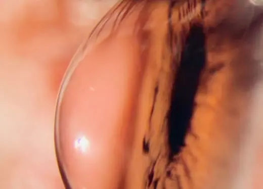 banner módulo córnea