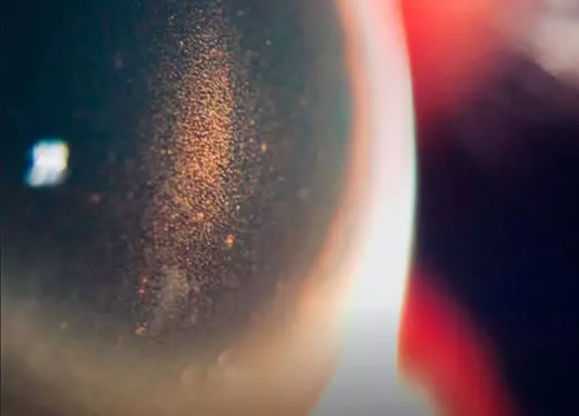 banner módulo glaucoma