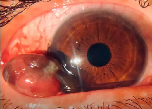 banner módulo tumores